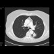 Small cell carcinoma of the lung: CT - Computed tomography